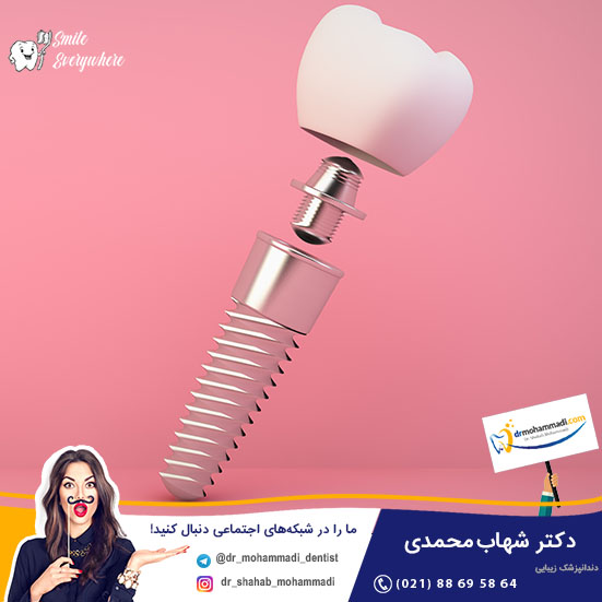 ایمپلنت اقساط، ایمپلنت قسطی در ۳ قسط - کلینیک دندانپزشکی دکتر شهاب محمدی